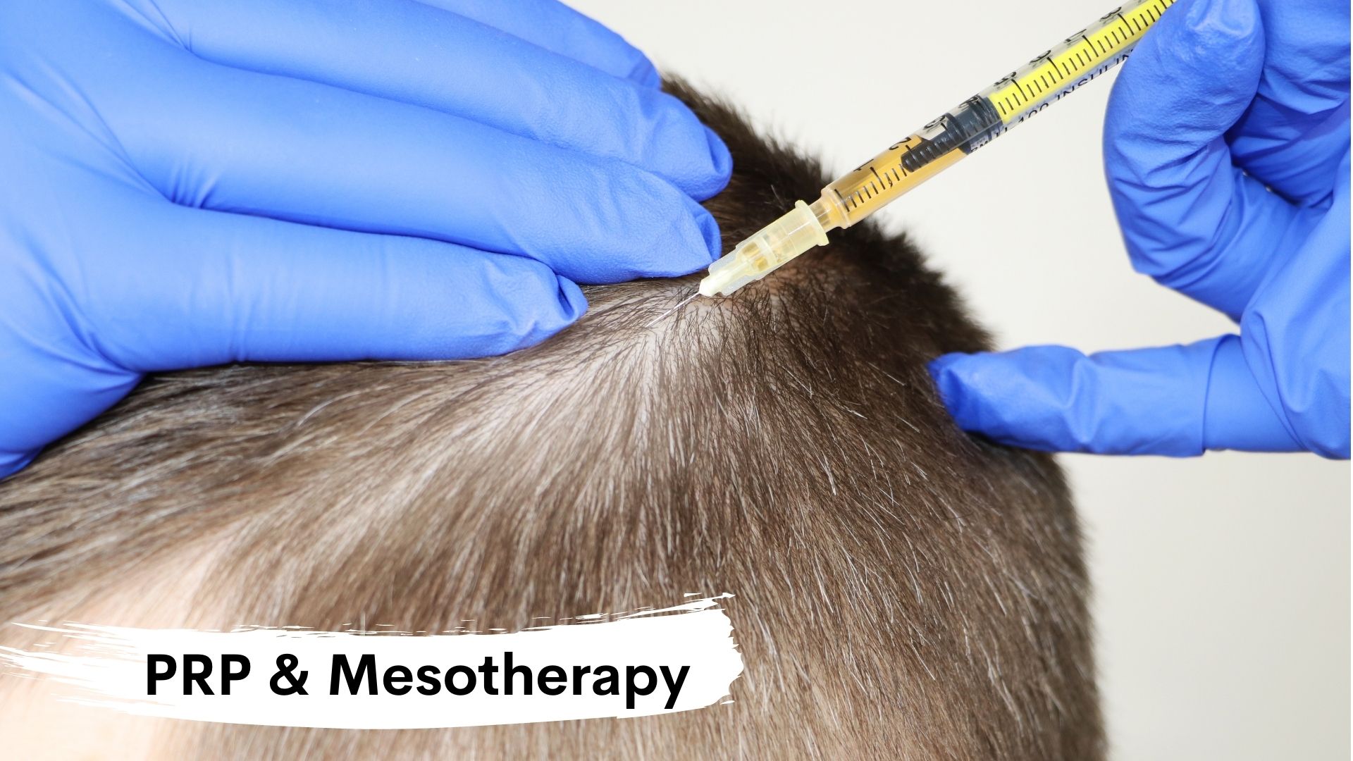 prp and mesotherapy